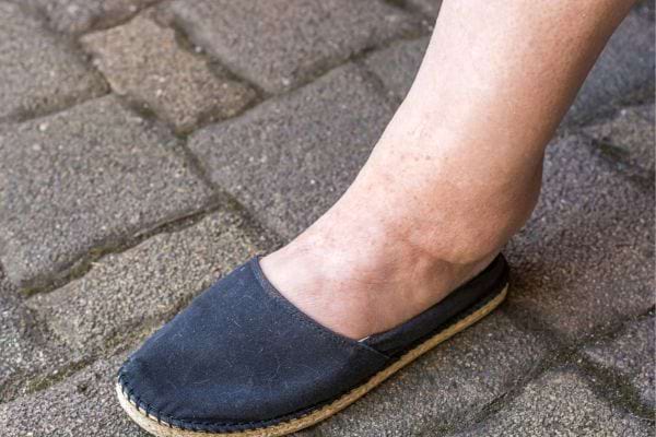 Pieds gonflés avec marques apparentes