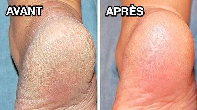 Le Vicks VapoRub ne sert pas qu’à déboucher le nez : 10 usins insoupçonnés qui vont vous surprendre