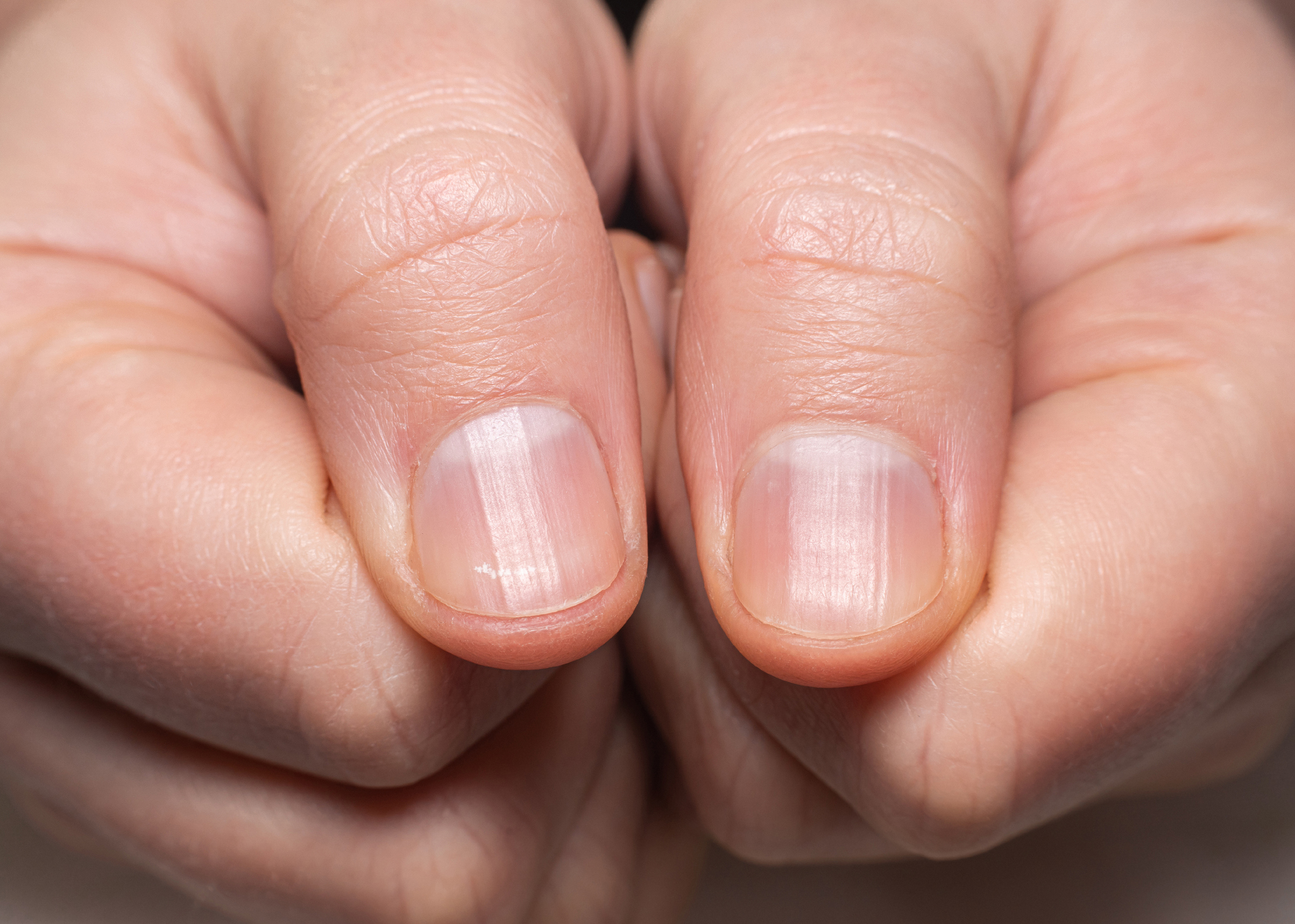 Ongles striés : décryptage des causes et solutions naturelles à adopter
