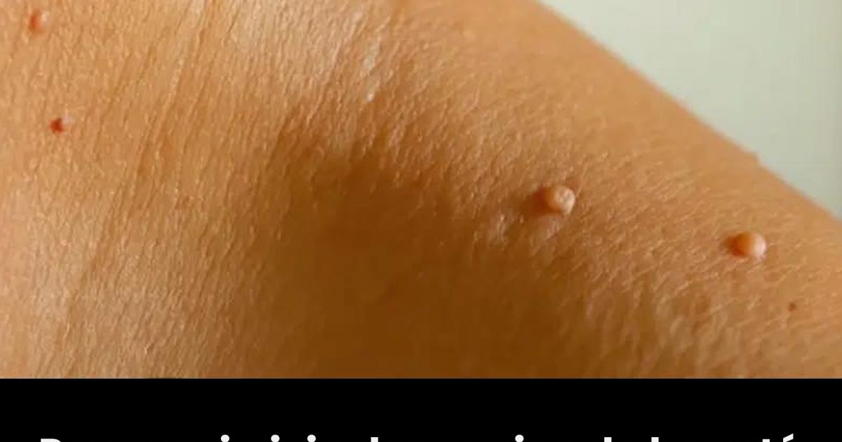 Pourquoi ai-je des grains de beauté couleur chair sur le cou ou sous les aisselles, et comment m’en débarrasser ? Des experts vous expliquent