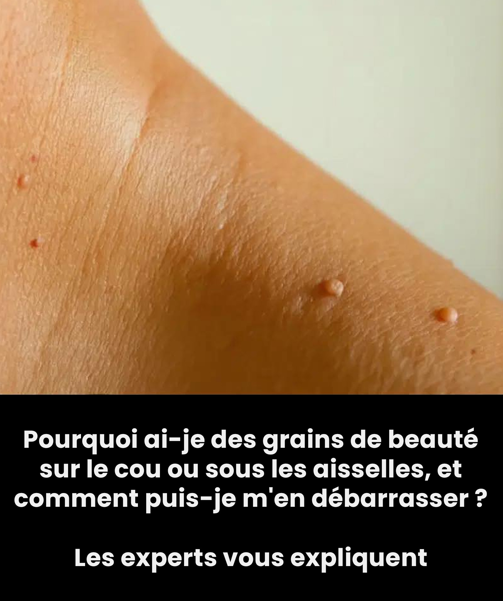 Pourquoi ai-je des grains de beauté couleur chair sur le cou ou sous les aisselles, et comment m’en débarrasser ? Des experts vous expliquent
