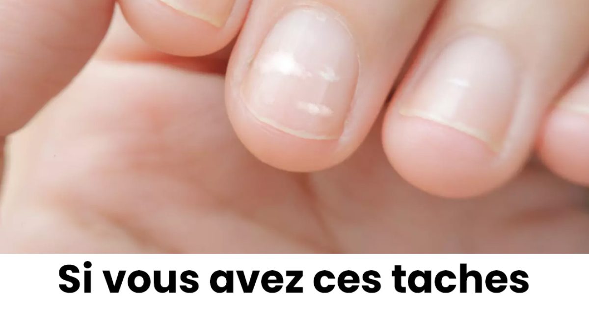 Pourquoi observe-t-on parfois des taches blanches sur les ongles ?