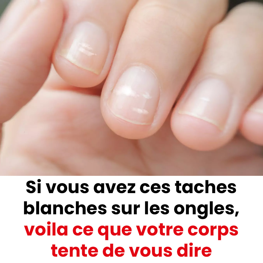 Pourquoi observe-t-on parfois des taches blanches sur les ongles ?
