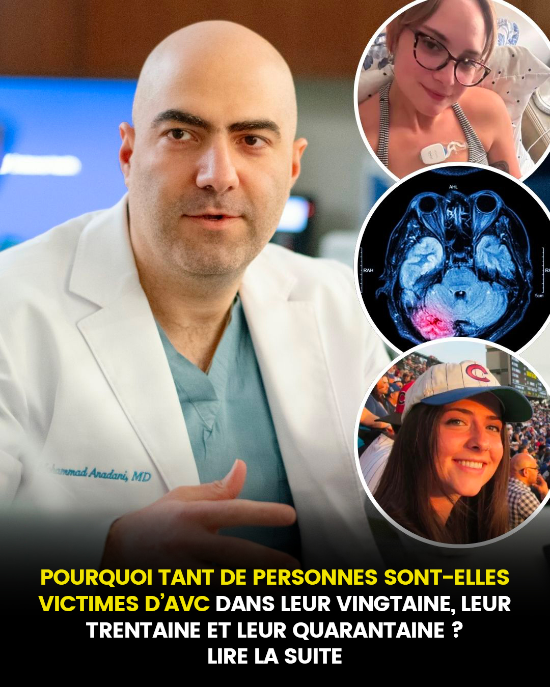 Pourquoi tant de personnes sont victimes d’AVC dans la vingtaine, la trentaine et la quarantaine : « Nous n’avons jamais eu de patients aussi jeunes »