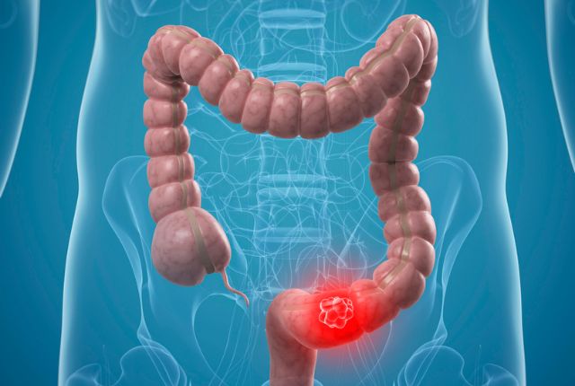 Ces 5 signaux d’alerte du cancer colorectal que vous ne devez surtout pas négliger