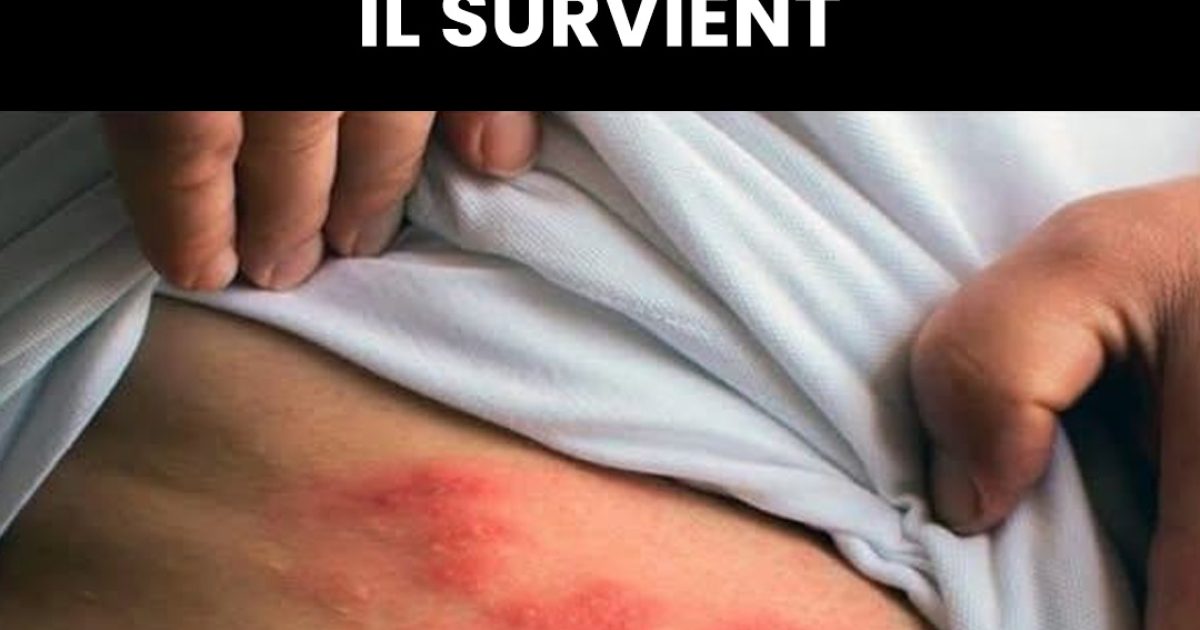 Qu’est ce que que le Zona et quels sont ses symptômes ?