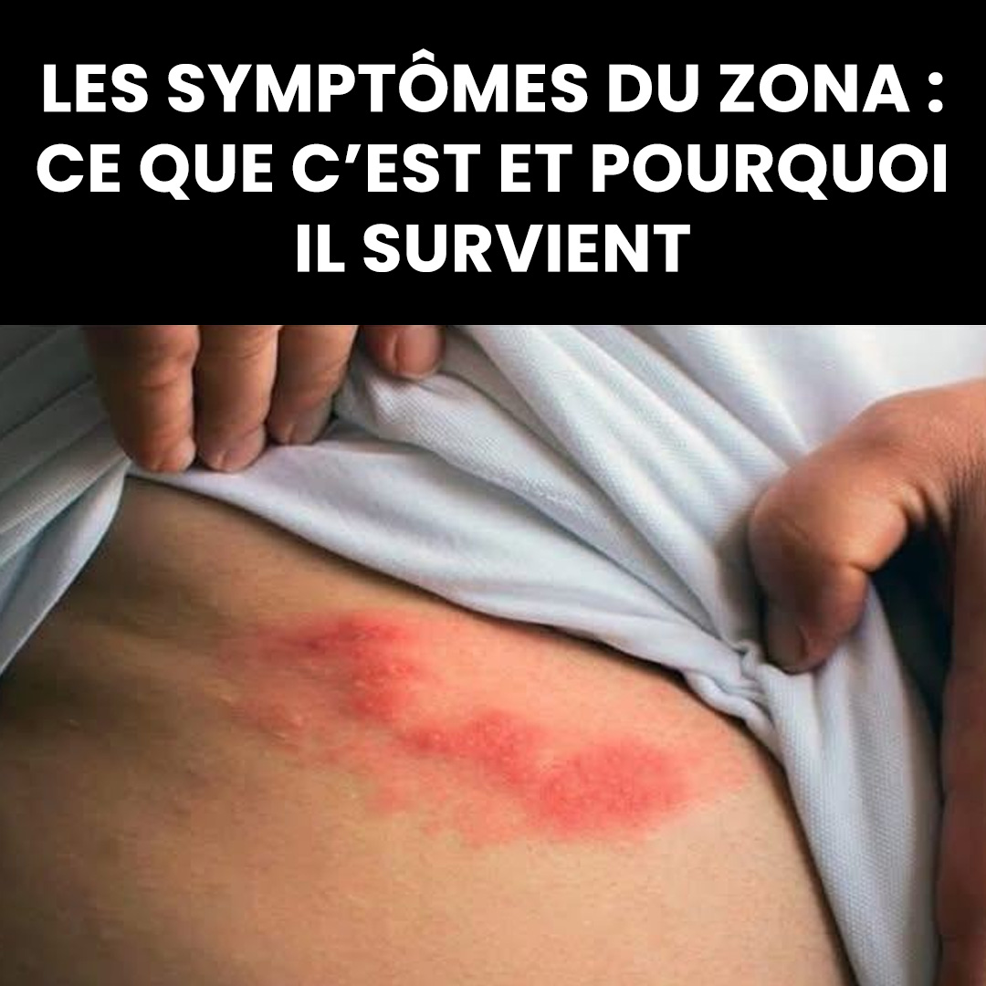 Qu’est ce que que le Zona et quels sont ses symptômes ?