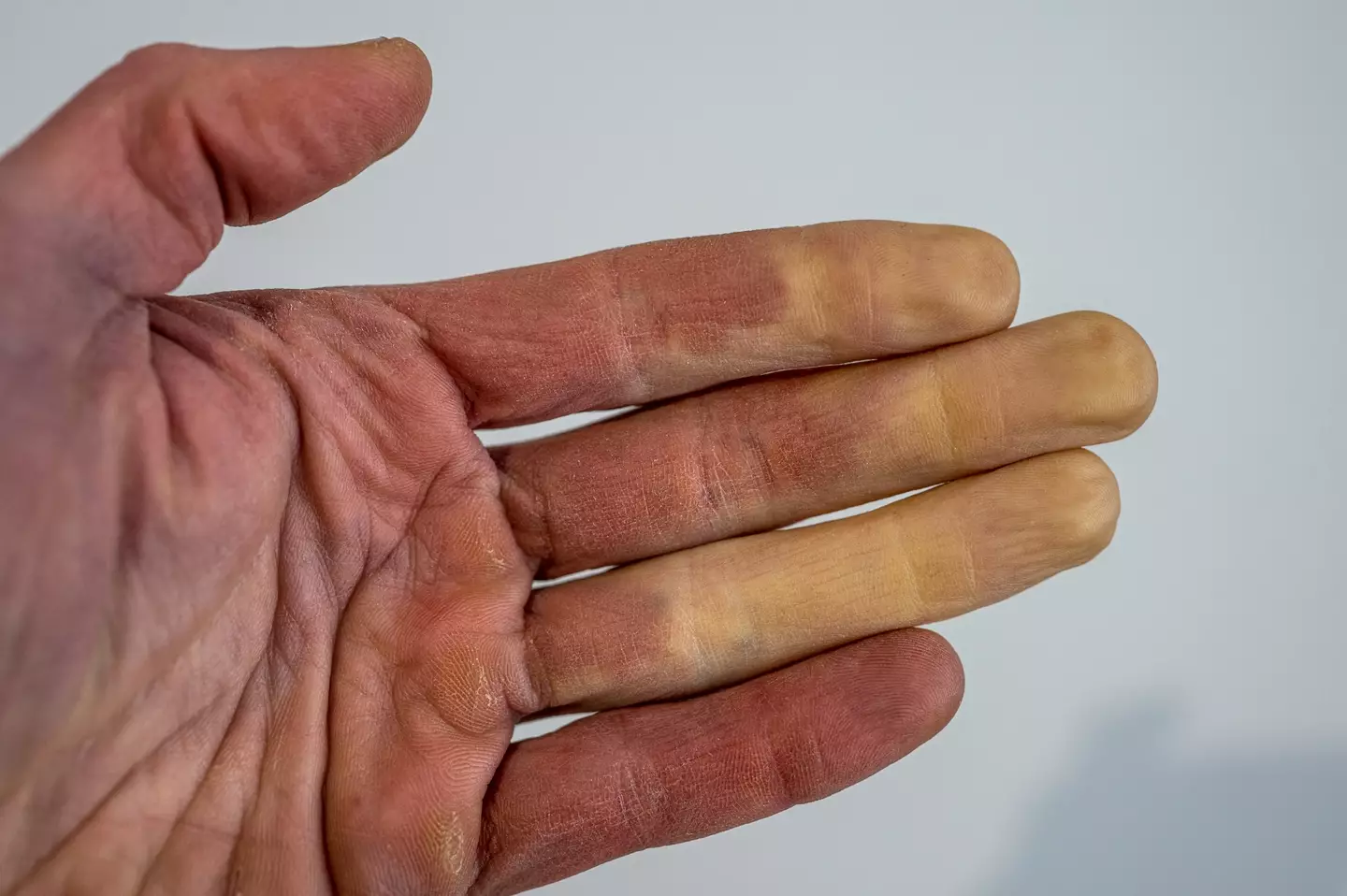 Pourquoi un doigt devient soudainement blanc sous l’effet du froid : l’explication surprenante