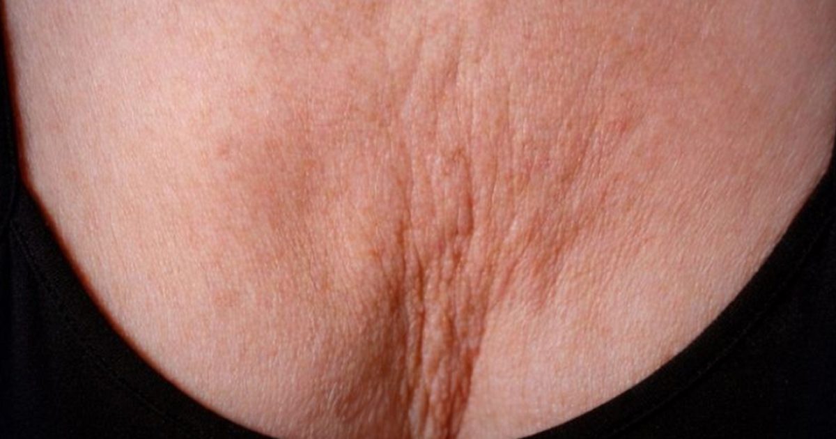 Rides du décolleté : 5 conseils pour les prévenir et les atténuer