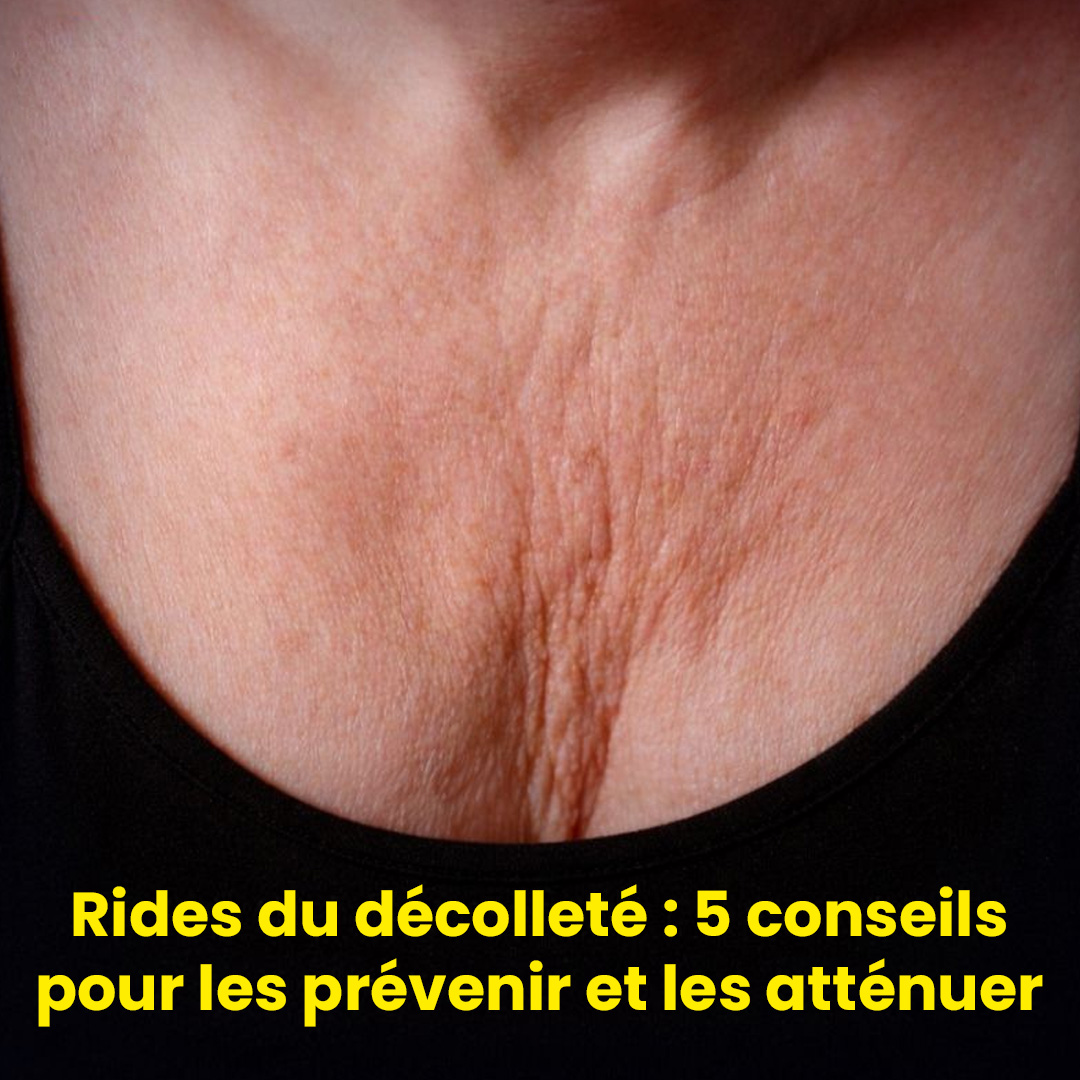 Rides du décolleté : 5 conseils pour les prévenir et les atténuer