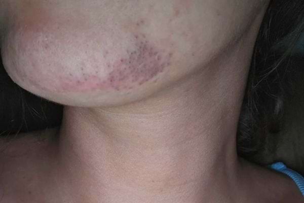 Poils au menton chez la femme : mythes, causes réelles et solutions pour s’en libérer