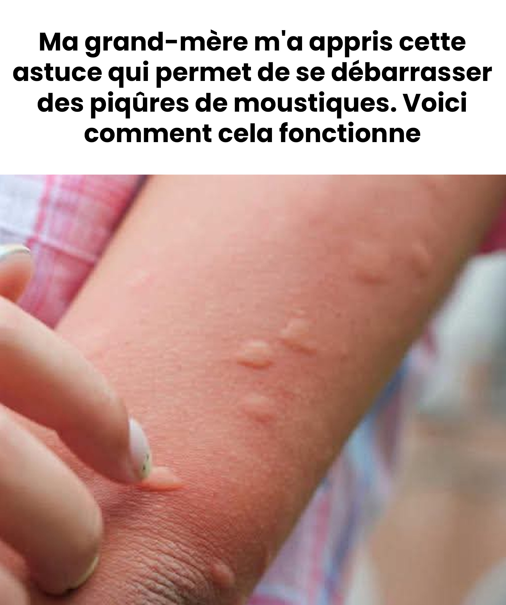 Se brûler pour ne plus se gratter ? La vérité sur la cuillère chaude contre les piqûres