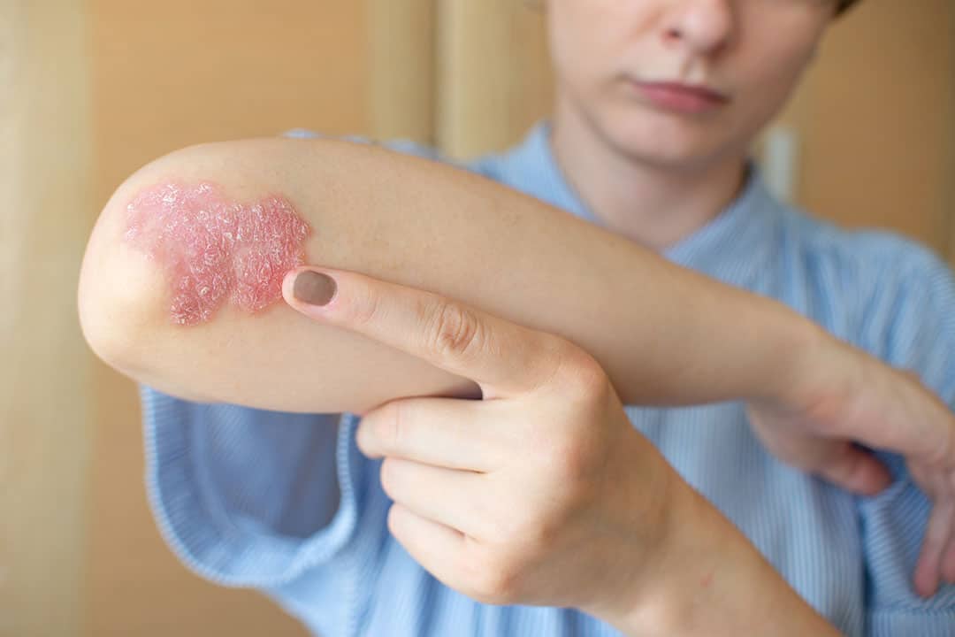 psoriasis sur le coude