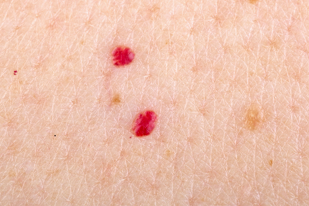 Ces petites taches rouges sur votre peau : ce qu’elles révèlent vraiment (et quand s’inquiéter)