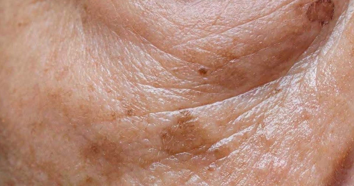 Si ce minéral vient à manquer, le risque de voir apparaître des taches de vieillesse augmente