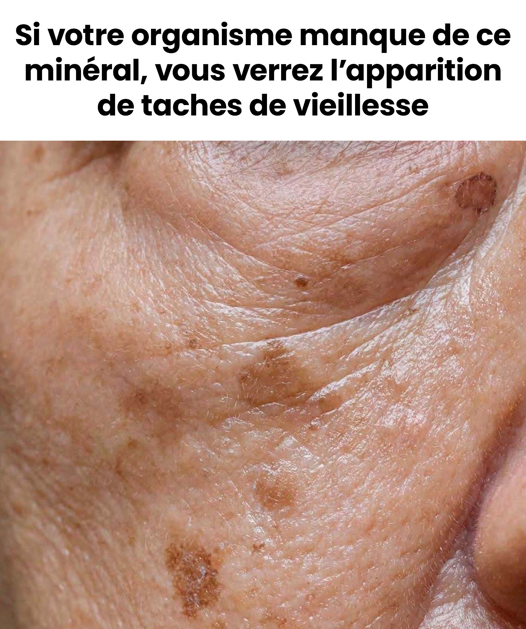 Si ce minéral vient à manquer, le risque de voir apparaître des taches de vieillesse augmente