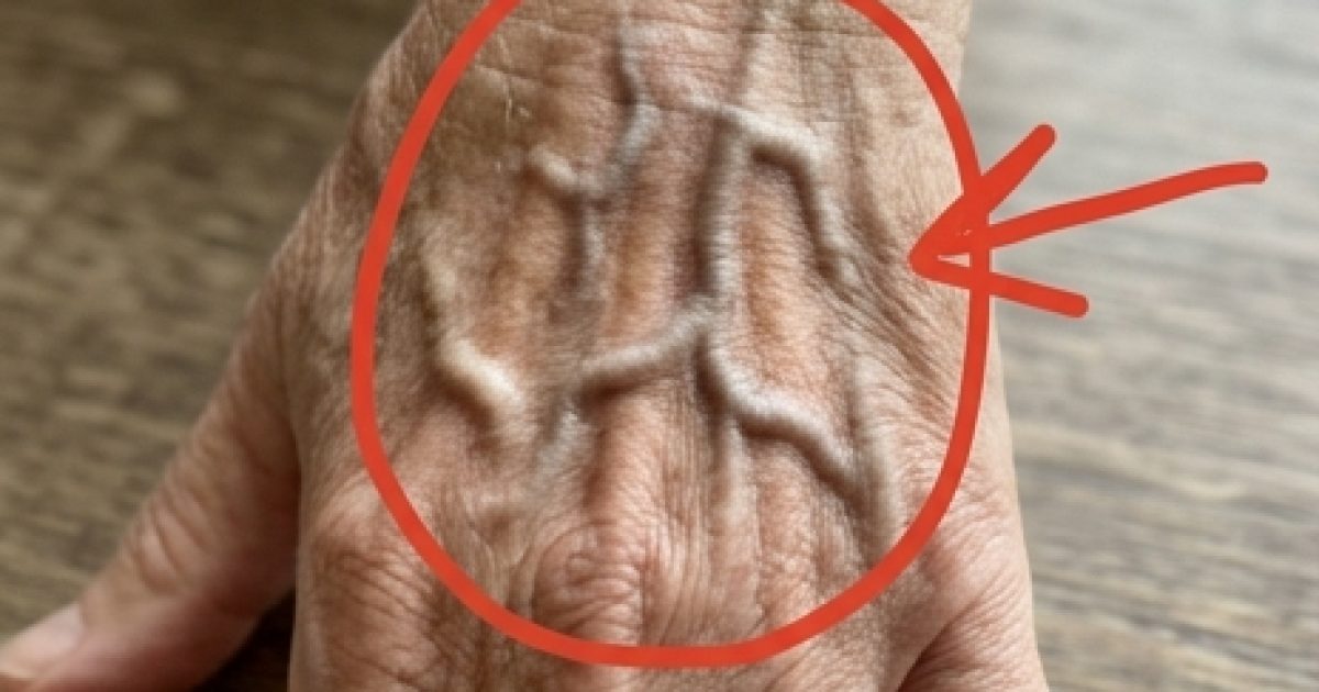 Si vos veines sont visibles, voici ce que cela signifie
