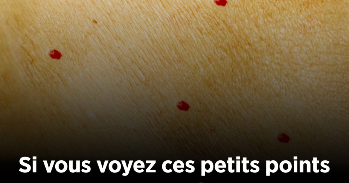 Si vous remarquez ces points rouges sur votre peau, voici ce qu’ils signifient