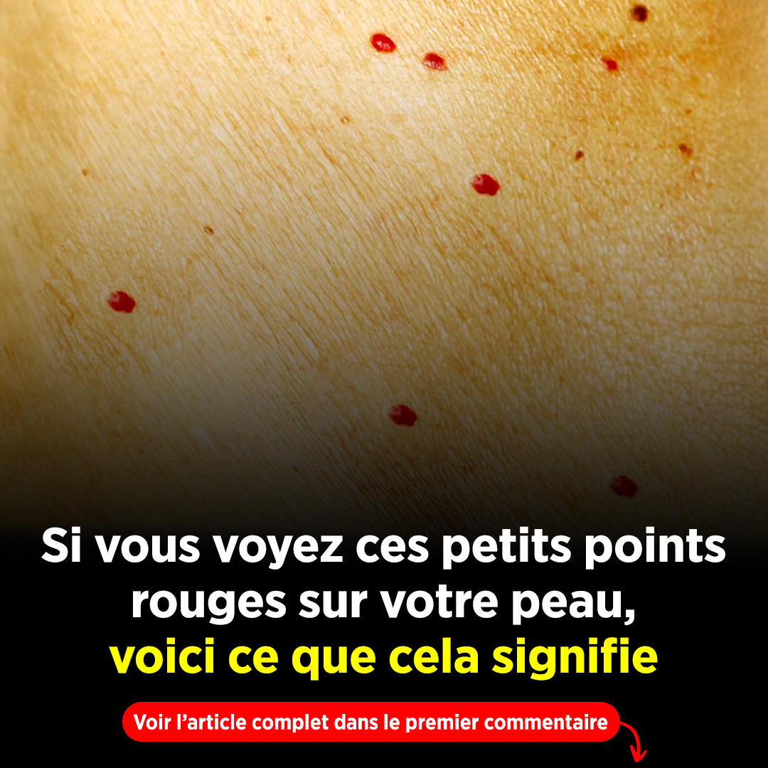 Si vous remarquez ces points rouges sur votre peau, voici ce qu’ils signifient