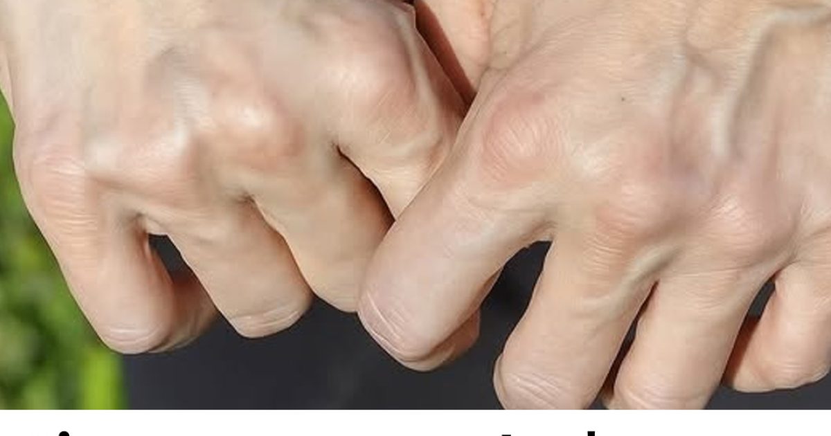 Signification et conseils pour gérer les veines gonflées