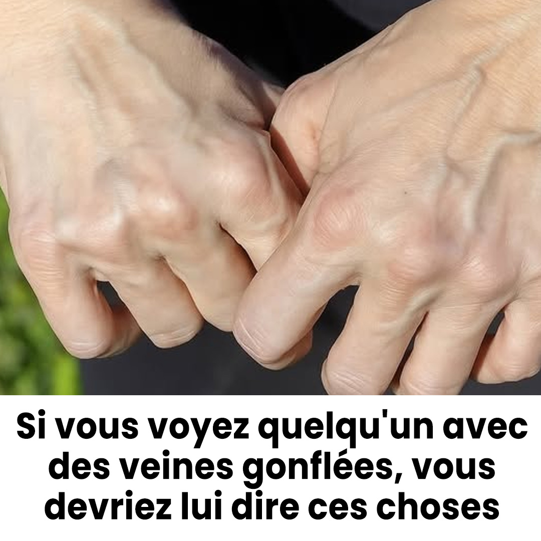 Signification et conseils pour gérer les veines gonflées