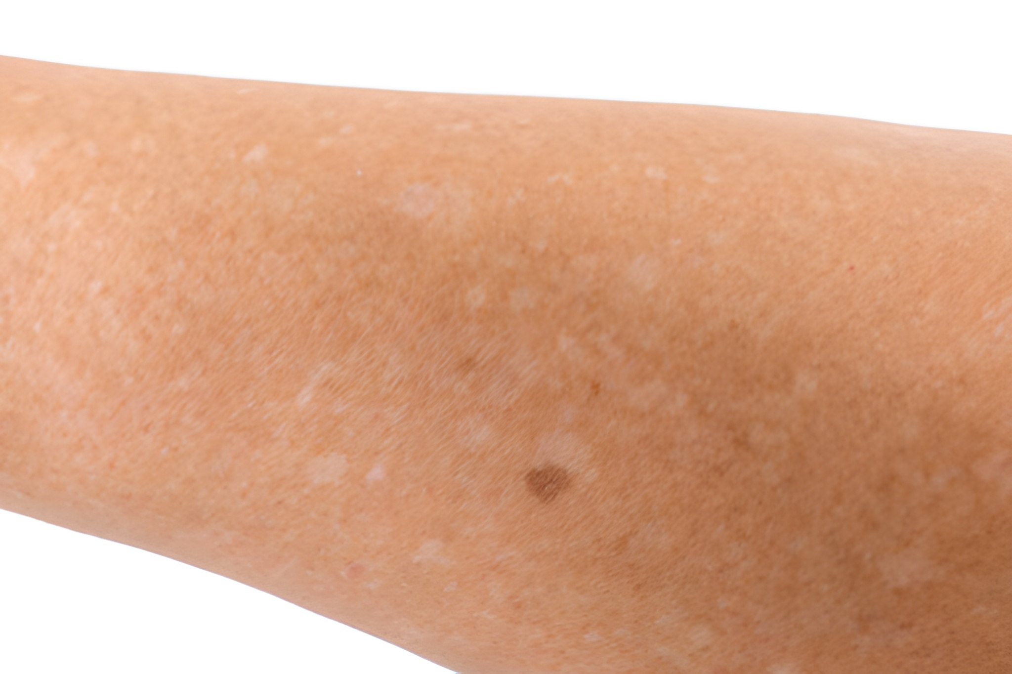 Ces taches claires sur la peau qui apparaissent après l’été : faut-il vraiment s’inquiéter ?