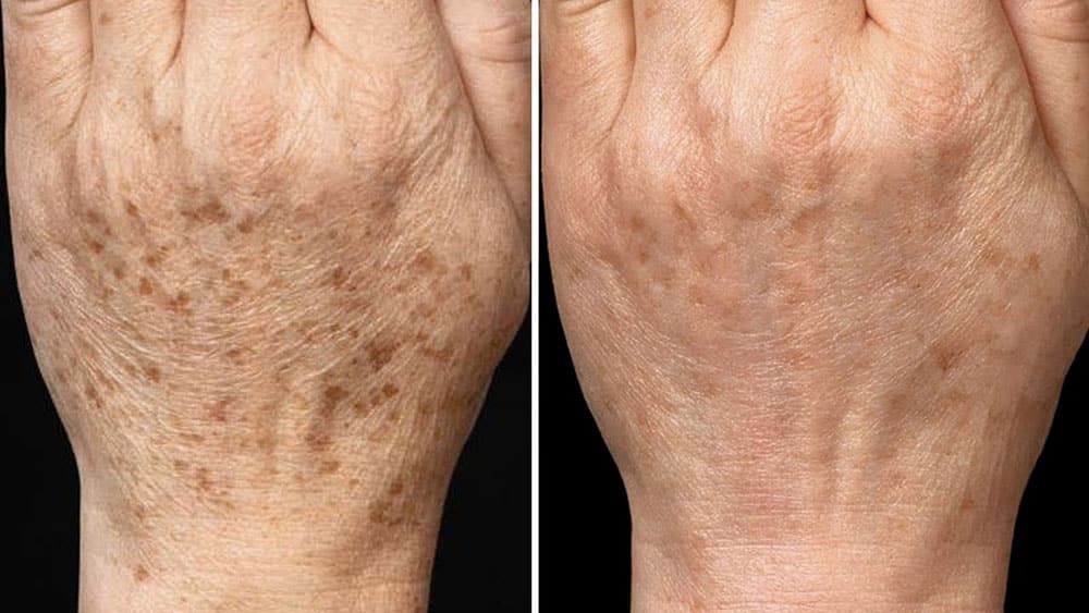Taches brunes sur les mains : d’où viennent-elles et comment les estomper naturellement ?