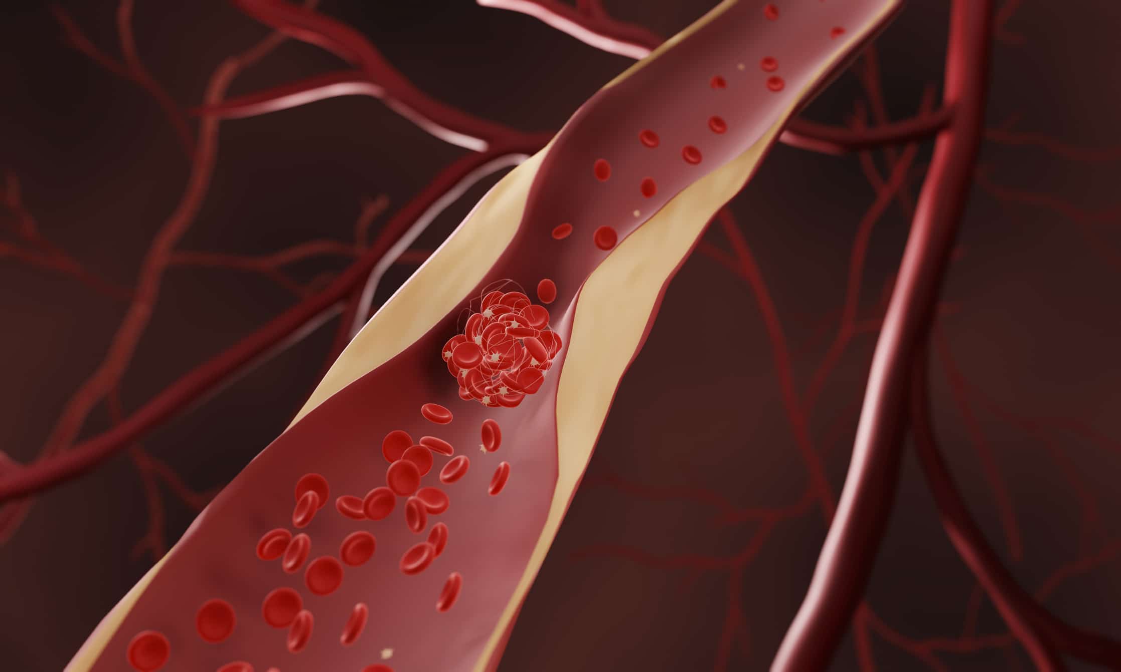 Illustration d'un caillot sanguin dans une veine