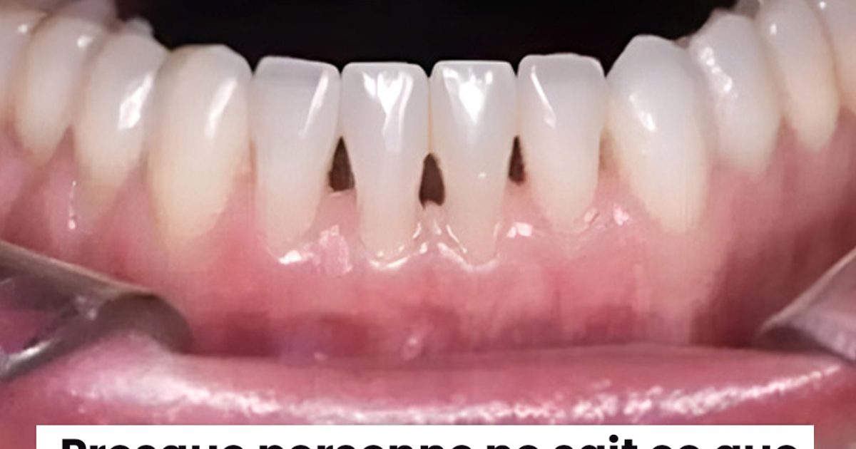 Triangles noirs entre les dents : un dentiste explique ce que cela révèle sur votre santé bucco-dentaire