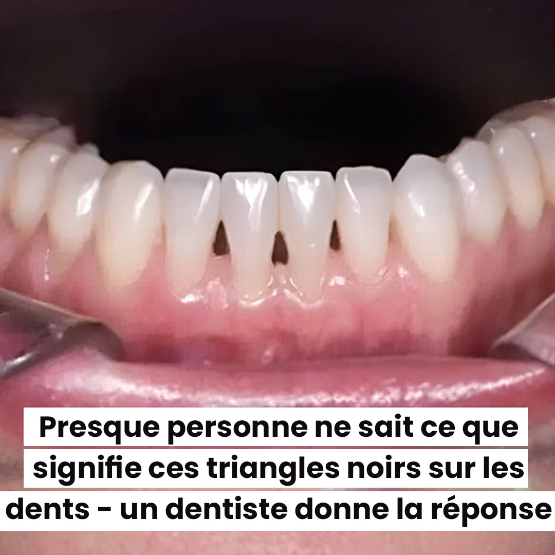 Triangles noirs entre les dents : un dentiste explique ce que cela révèle sur votre santé bucco-dentaire