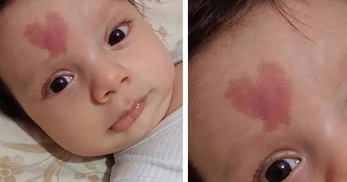 Un bébé est né avec une tache de naissance en forme de cœur sur le front. À quoi ressemblera-t-il à l'âge de 6 ans ?
