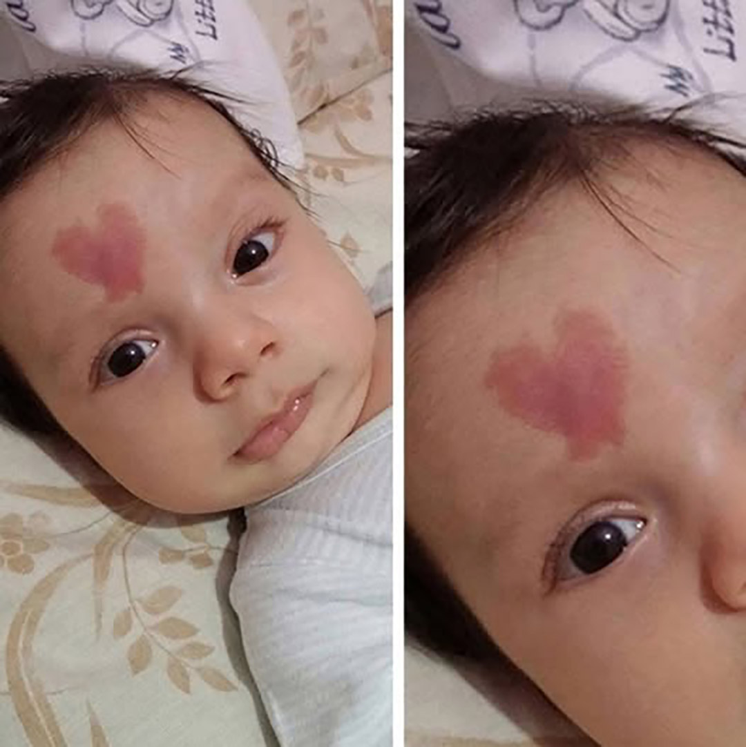 Un bébé est né avec une tache de naissance en forme de cœur sur le front. À quoi ressemblera-t-il à l'âge de 6 ans ?