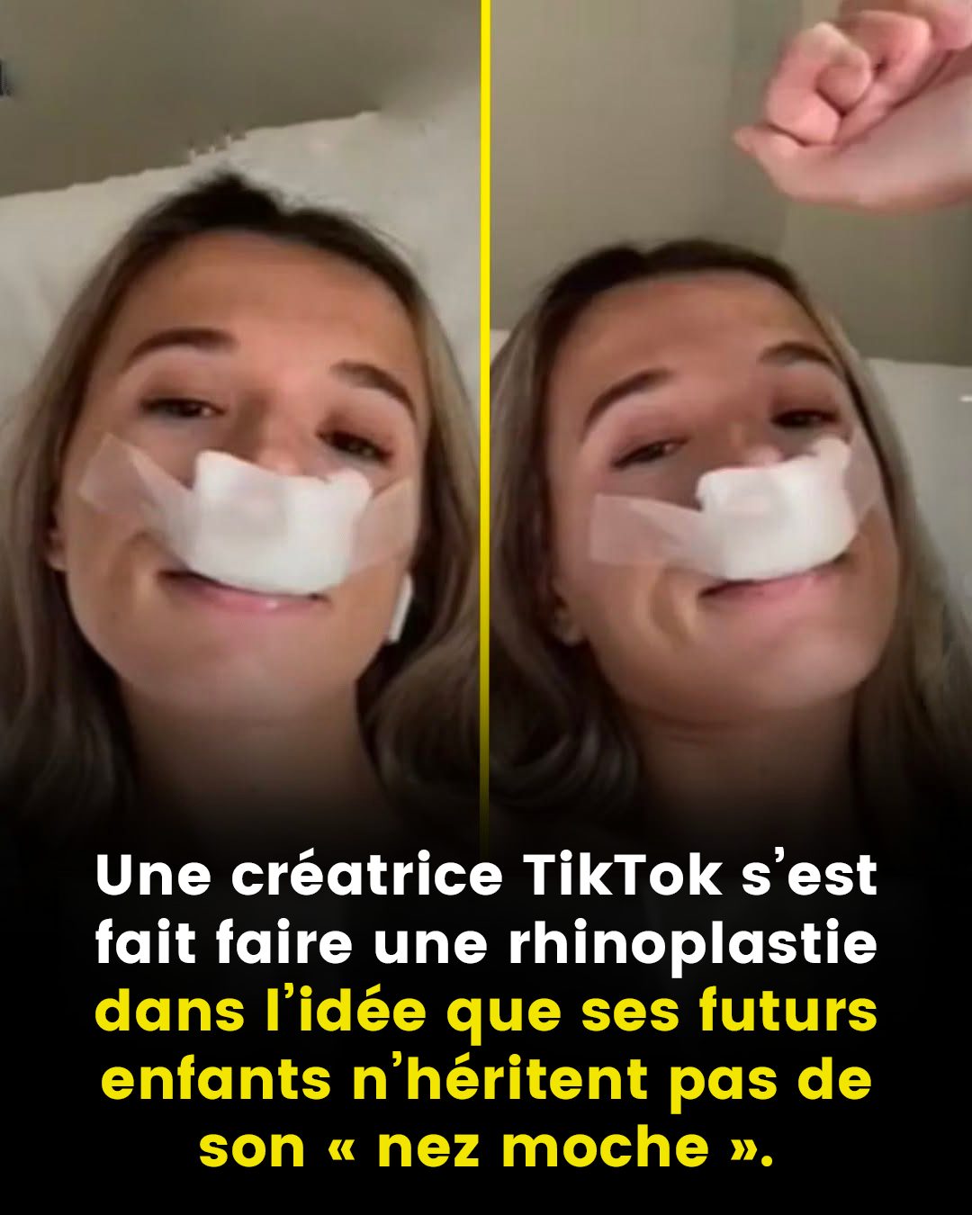 Un créateur TikTok s’est fait faire une rhinoplastie dans l’idée que ses futurs enfants n’héritent pas de son « nez moche »