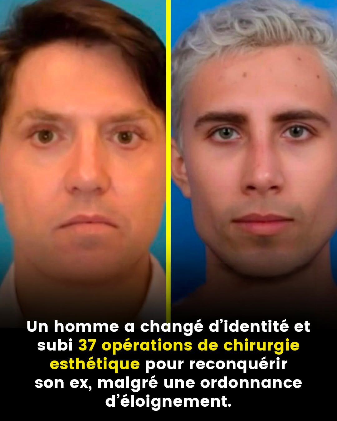 Un homme a changé d’identité et subi 37 opérations de chirurgie esthétique pour revenir auprès de son ex, malgré une ordonnance d’éloignement
