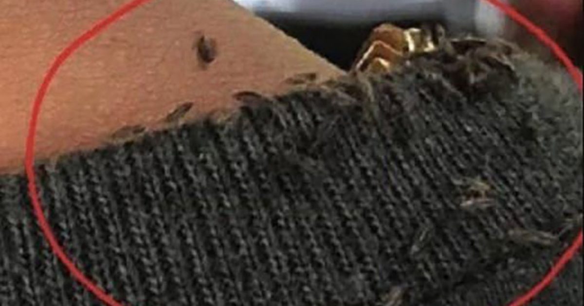 Un homme devient viral sur le WEB à cause d’une infestation extrême de poux