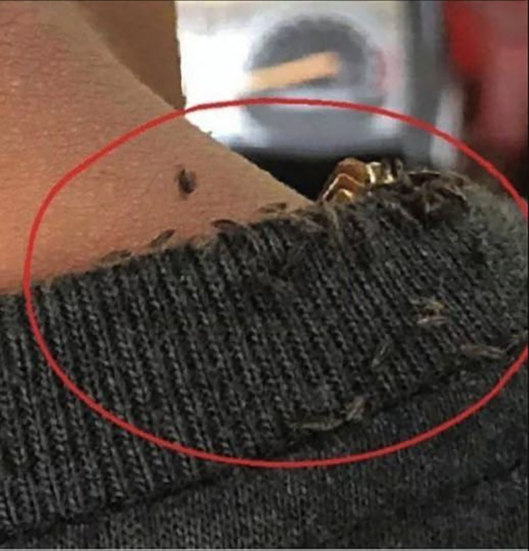 Un homme devient viral sur le WEB à cause d’une infestation extrême de poux