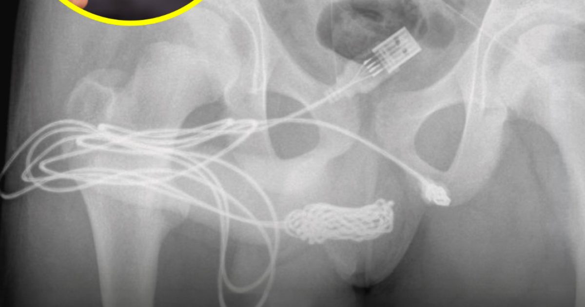 Un jeune homme a été transporté d’urgence à l’hôpital après s’être retrouvé avec un câble USB coincé dans l’urètre : il essayait de mesurer son pénis et le câble s’est emmêlé
