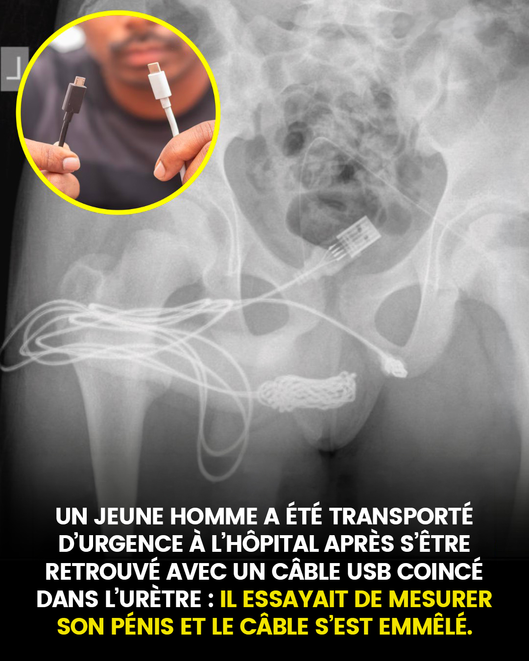 Un jeune homme a été transporté d’urgence à l’hôpital après s’être retrouvé avec un câble USB coincé dans l’urètre : il essayait de mesurer son pénis et le câble s’est emmêlé