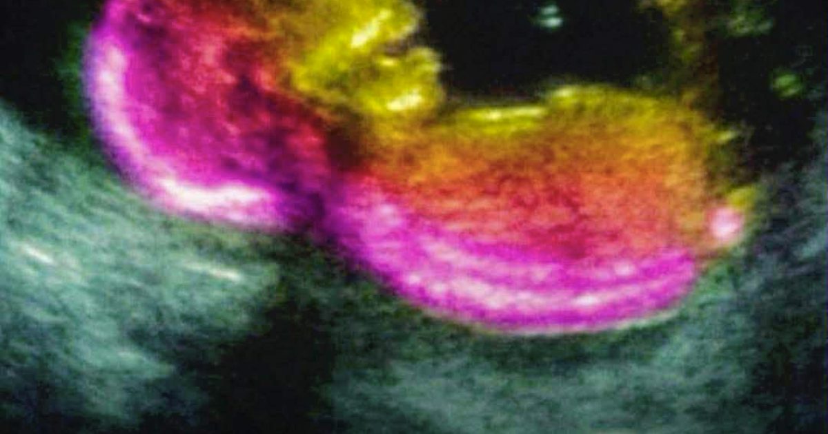 Une étude met en évidence une éventuelle corrélation avec le développement de l’autisme