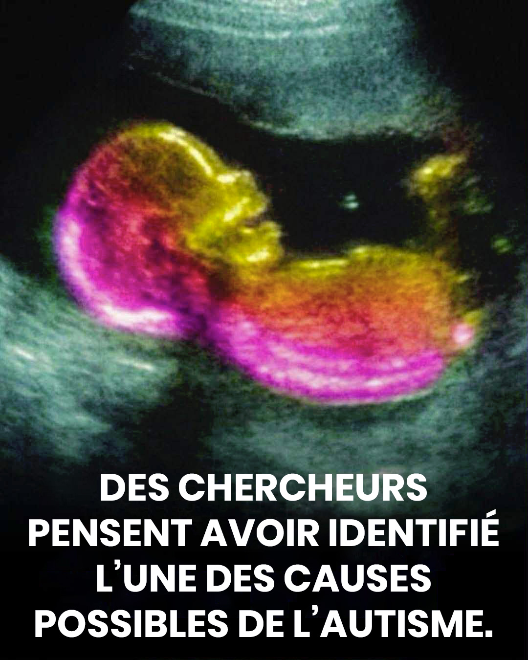 Une étude met en évidence une éventuelle corrélation avec le développement de l’autisme