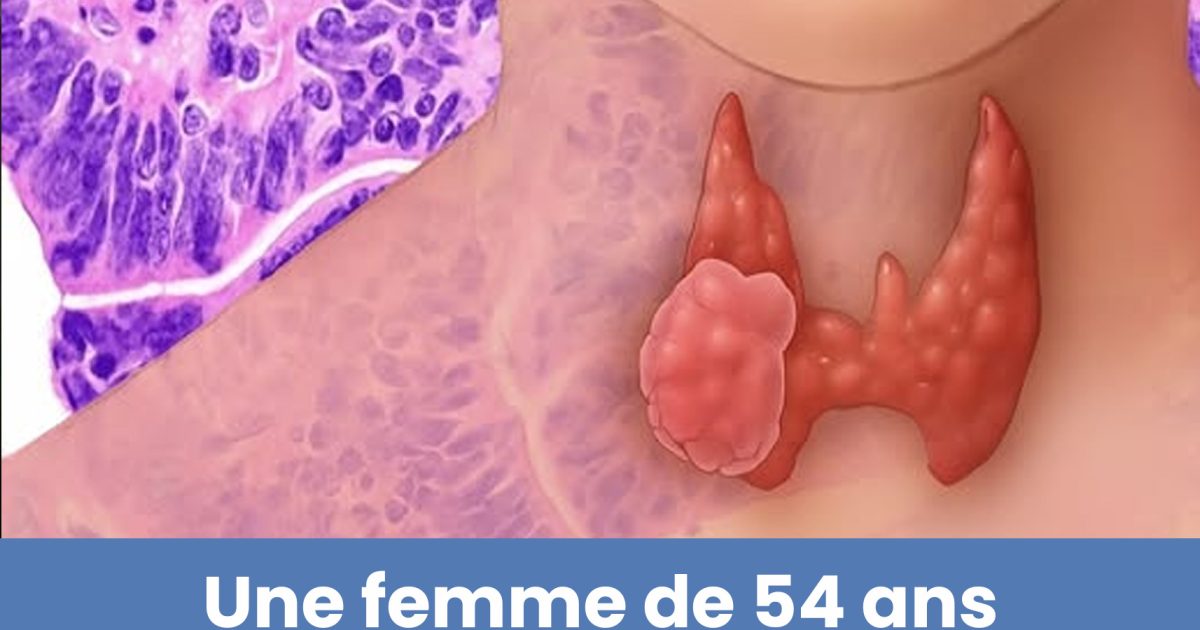 Une femme de 54 ans a découvert qu’elle souffrait d’un cancer de la thyroïde à partir d’un signe qui passe souvent inaperçu