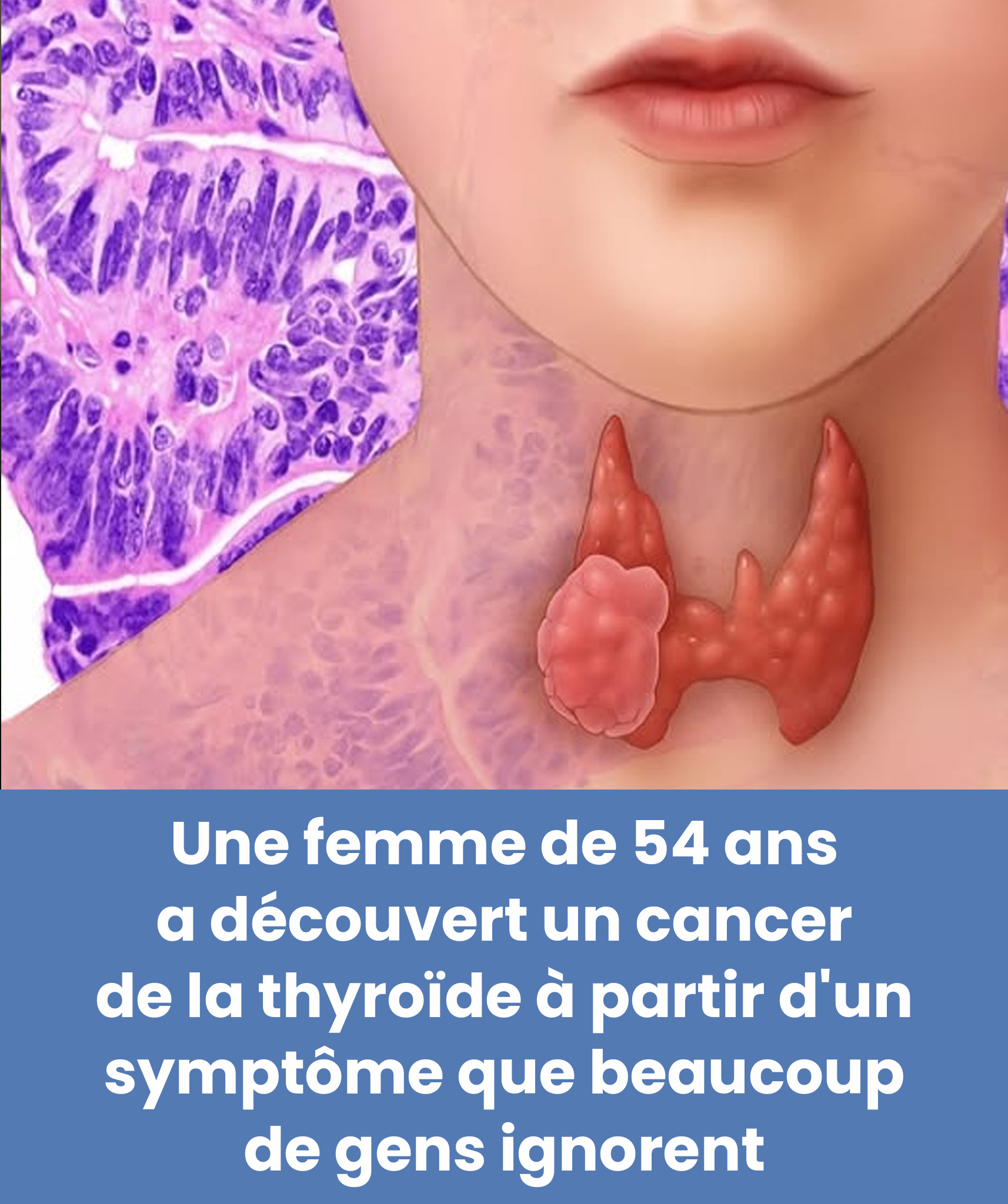 Une femme de 54 ans a découvert qu’elle souffrait d’un cancer de la thyroïde à partir d’un signe qui passe souvent inaperçu