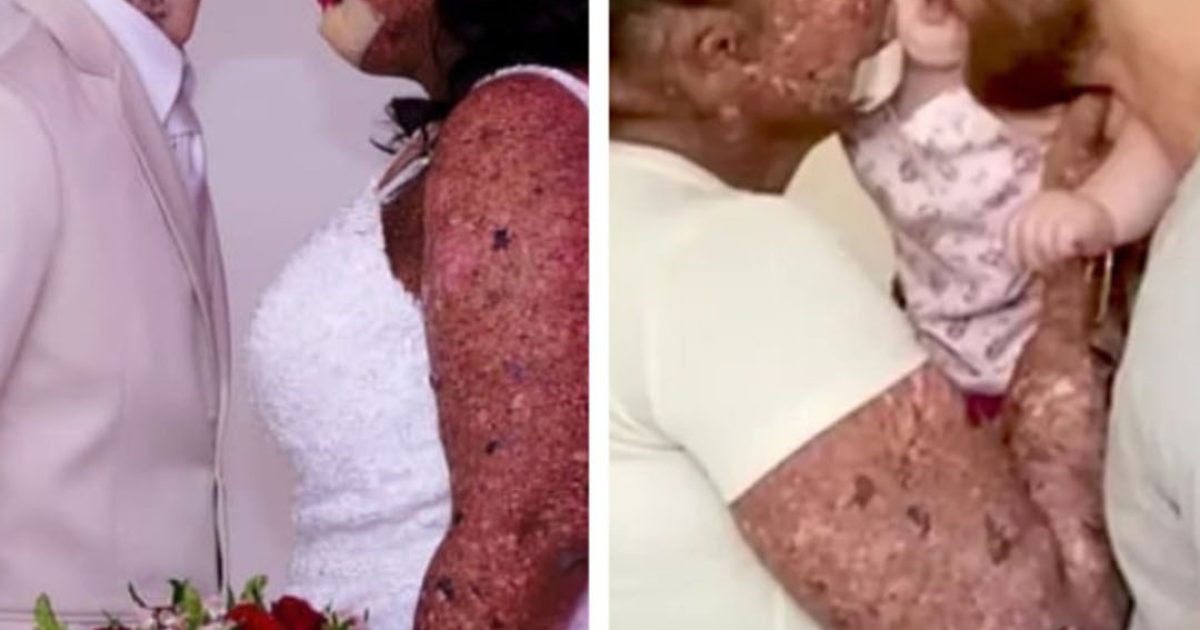 Une femme est traitée d’« irresponsable » pour avoir eu un bébé malgré sa maladie de peau… mais sa petite fille est devenue un vrai trésor de beauté.