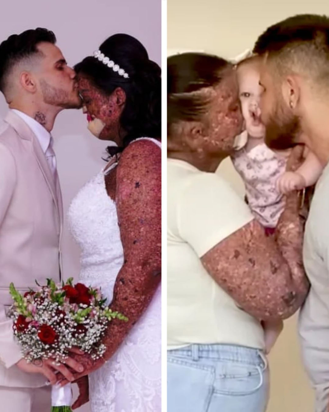 Une femme est traitée d’« irresponsable » pour avoir eu un bébé malgré sa maladie de peau… mais sa petite fille est devenue un vrai trésor de beauté.