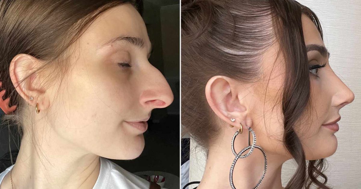 Une femme révèle le résultat de sa chirurgie esthétique, et sa transformation laisse tout le monde sans voix