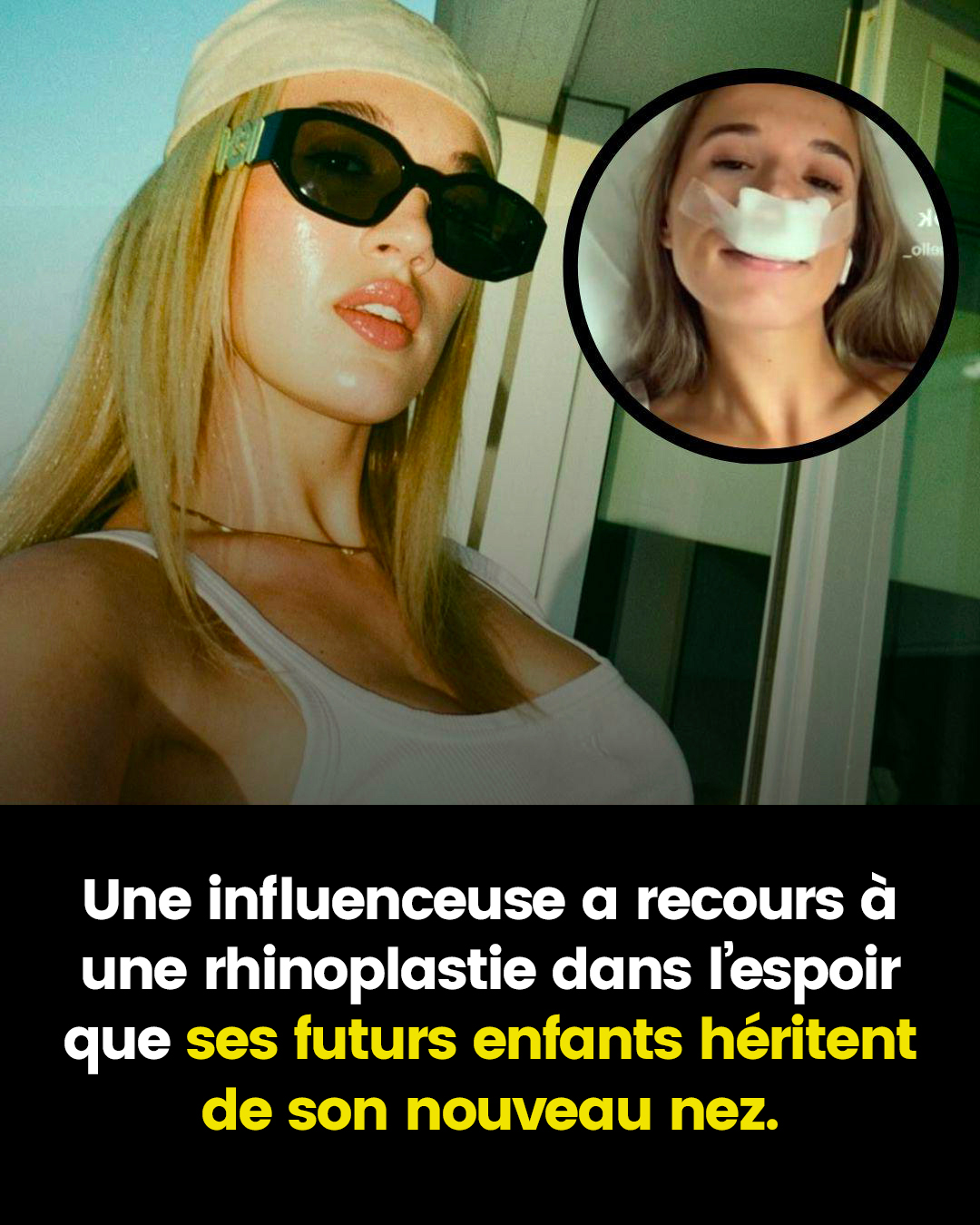 Une influenceuse affirme avoir subi une rhinoplastie dans l’idée que ses enfants puissent hériter de son nouveau nez
