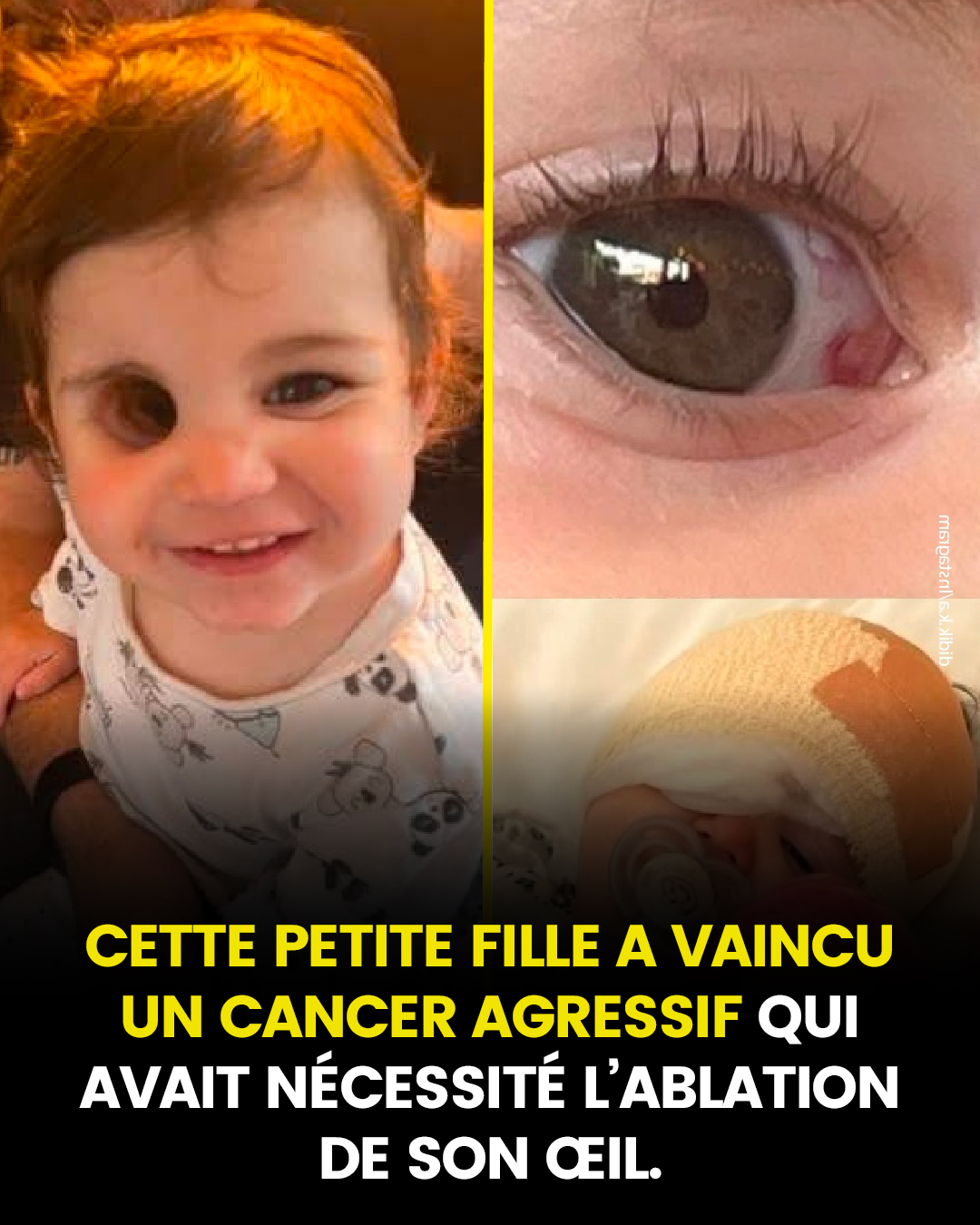 Une petite fille est née avec un cancer de l’œil agressif qui a nécessité l’ablation de son œil, et sa guérison a ému le cœur de beaucoup