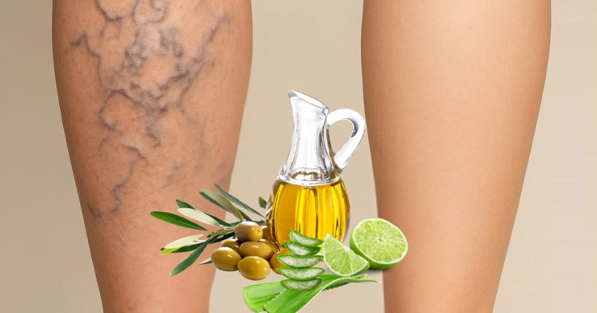 Varices : le remède de grand-mère 100 % naturel avec aloe vera, vinaigre et citron
