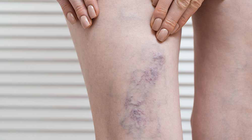 Varices apparentes sur des jambes