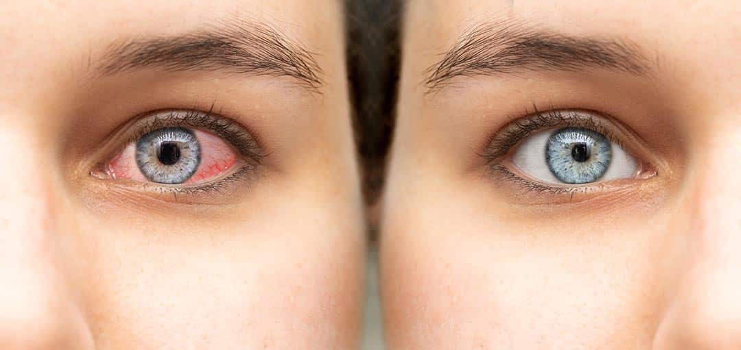 Image des yeux rouges